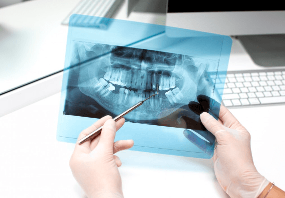 Brakuje jednego zęba – implant czy most? Porównanie danych, kosztów i trwałości